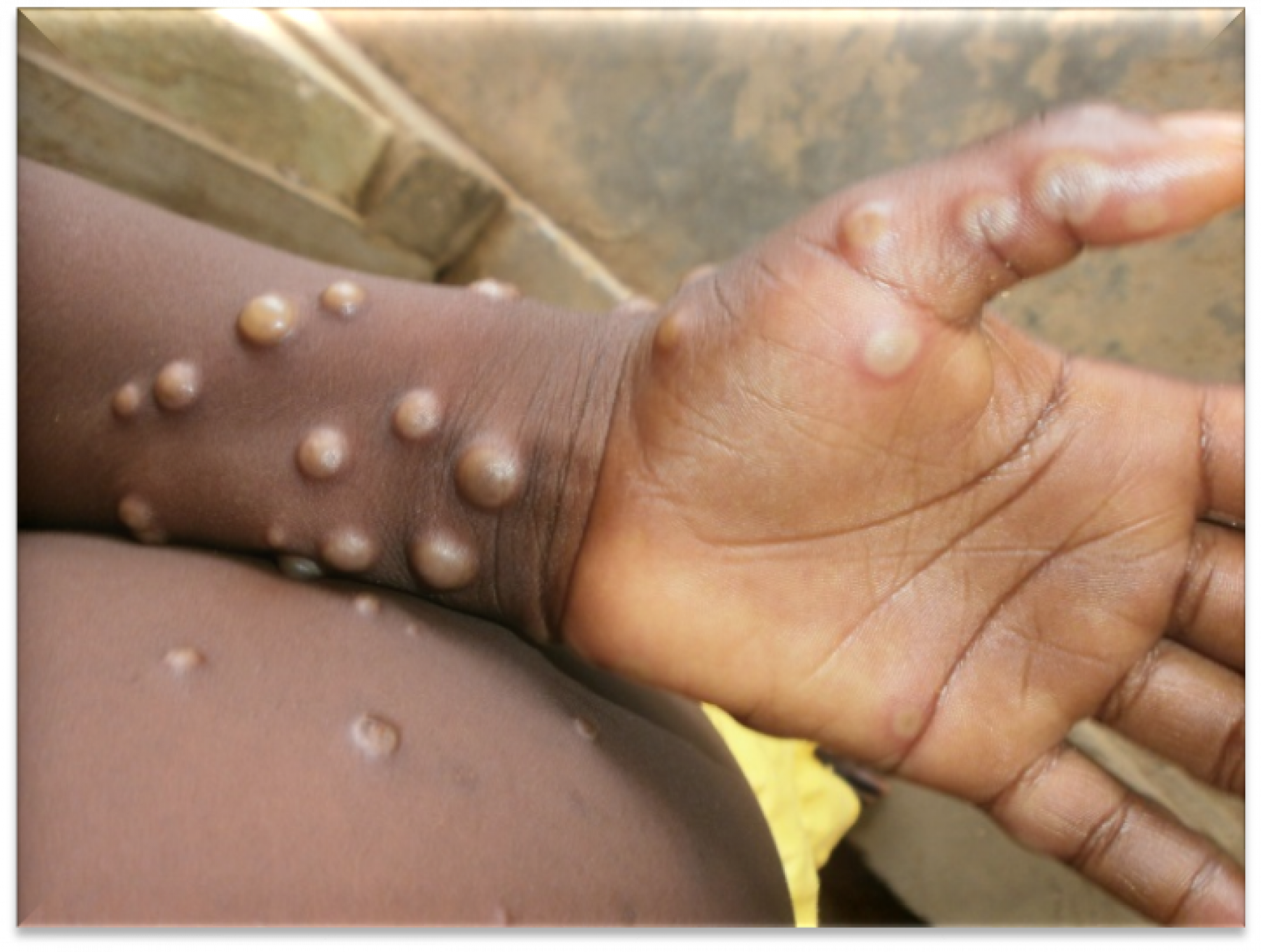 Monkeypox rashes