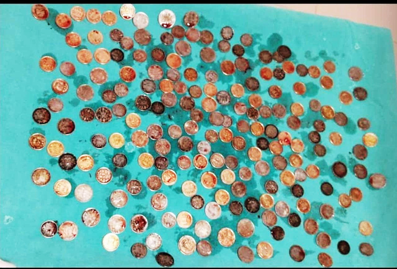 The coins removed from a Karnataka man. (Supplied)