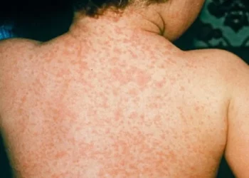 Malappuram Measles outbreak