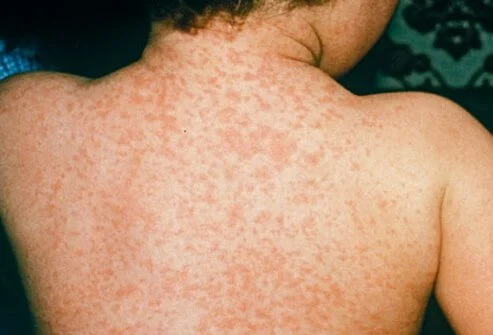 Malappuram Measles outbreak