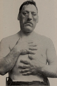 Acromegaly, showing enlarged facial features and hands.