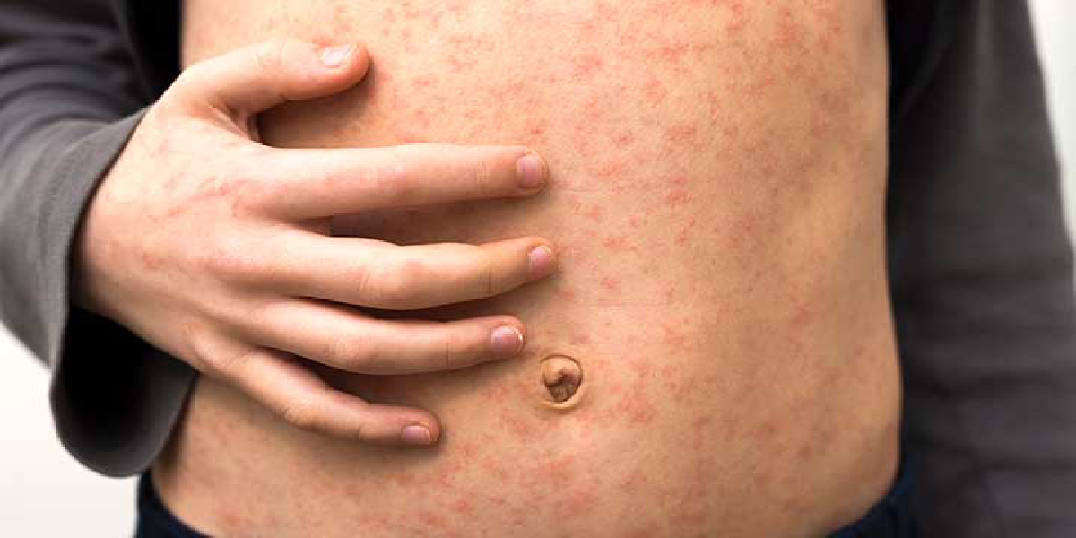 Measles outbreak in Malappuram