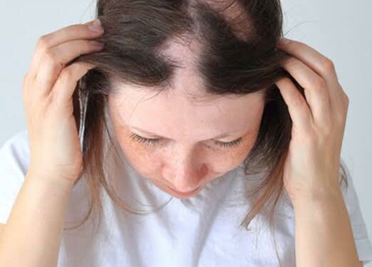 Representational impage of a patient with trichotillomania, where they pluck hair from parts of their body.