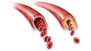 Atherosclerosis is the build-up of fats, cholesterol and other substances in and on the artery walls. (Wikimedia Commons)