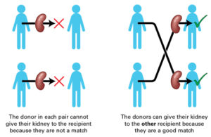 Representational image to show kidney swap transplant.