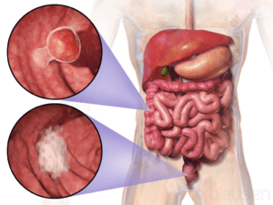 Colorectal cancer presentation (Wikimedia Commons)