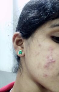 Acne due to cosmetics
