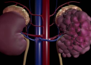 On World Kidney Day 2023, let us realise that high fat, low carb diets such as the keto diet have the inherent risk of damaging our kidneys