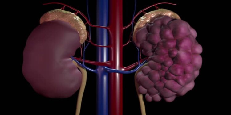 On World Kidney Day 2023, let us realise that high fat, low carb diets such as the keto diet have the inherent risk of damaging our kidneys