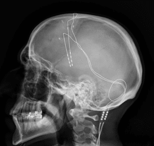 X-ray of deep brain stimulation. (Wikimedia Commons)