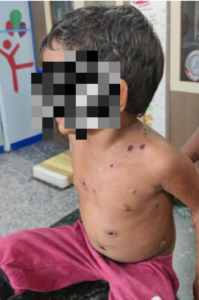 Small child infected with chickenpox. (Supplied)