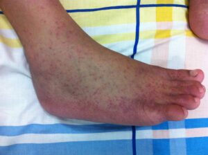 Chikungunya rash on the foot. (Wikimedia Commons)