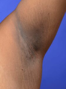 Acanthosis nigricans. (Wikimedia Commons)