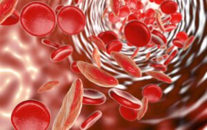 Karnataka identifies 8 districts to start screening for sickle cell anaemia; state's efforts appreciated, but doctors say more work needed.