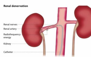 Renal denervation therapy. (CIRSE)