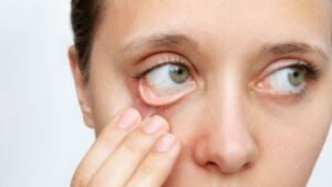 Paleness in the inner eyelids is a telltale sign of anaemia. (iStock)