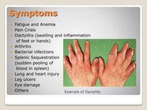 Symptoms of Sickle Cell Disease
