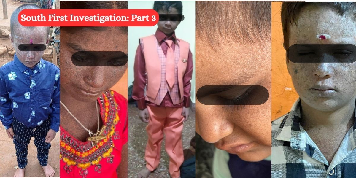 Xeroderma Pigmentosum: Ball now in government’s court, but it has miles to go to save children from premature death