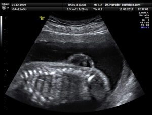 An ultrasound can be used to detect congenital conditions like a myelomeningocele. (Wikimedia Commons)
