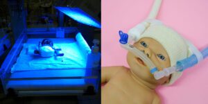 Phototherapy treatment (left) andThe Nasal Continuous Positive Airway Pressure nCPAP treatment for respiratory distress. (