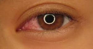 Incidence of dry eye disease has increased recently. (Creative Commons)