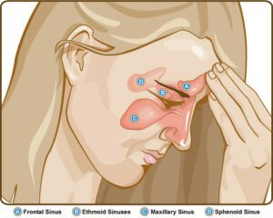 Sinusitis is an inflammation of the tissue lining the sinuses. (Flickr) 
