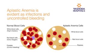 Aplastic anaemia. (Yashoda Hospital)