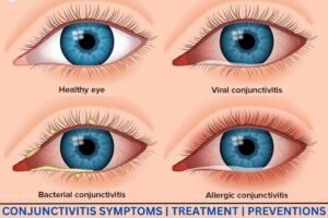 Different types of conjunctivitis. (Yashoda Hospital) 