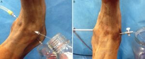 Arthroscopic knee joint lavage. (Wiley Online Library)