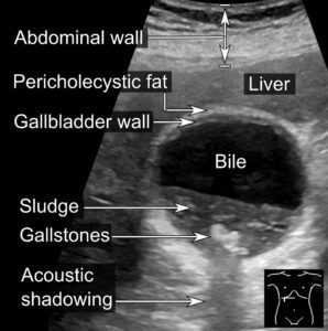 Gallbladder sludge and stones as seen in an ultrasound. (Wikimedia)