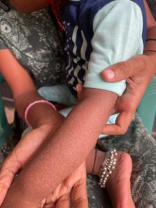 The condition appeared dot-like on Deeksha's skin. (Chetana Belagere/South First)