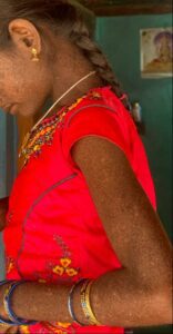 Savitha's skin condition. (Chetana Belagere/South First)