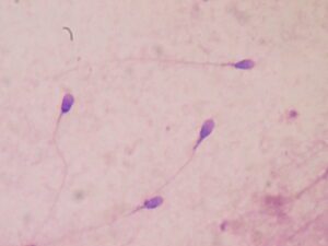 There have been reports of abnormal sperm analysis post Covid infection. (Wikimedia Commons)