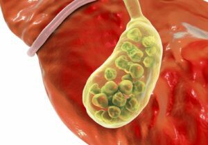 gallbladder stones