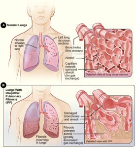 Interstitial lung disease refers to a group of about 100 chronic lung disorders characterized by inflammation and scarring. (NHLBI) 