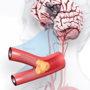 A pictorial representation of blockage in one of the arteries to the brain. (American Stroke Association) 