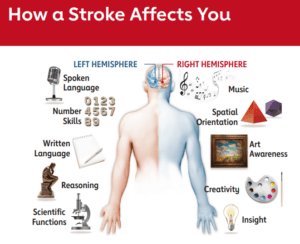 A stroke on the left side of the brain affects the right side of the body and vice versa. (American Stroke Association)