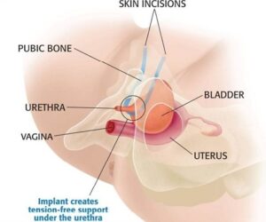 Transobturator Tape procedure. (Dr Ulhas Pote)