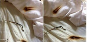 A pillow cover burnt by a phone charger. (Sourced)