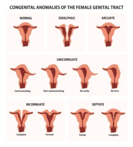 Congenital anomalies of the female reproductive system. (Shutterstock)