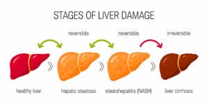 Stage of liver damage and their reversibility. (Health Central)
