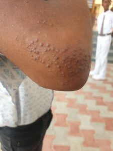 Scabies rashes. (South First)