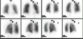 Ventilator/perfusion scan. (Wikimedia Commons)