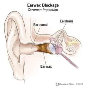 Earwax blockage. (Cleveland Clinic)