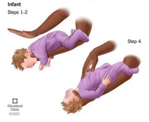 Heimlich maneuver on a baby. (Cleveland Clinic)