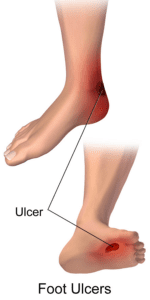 Diabetic foot ulcers. (Wikimedia Commons)