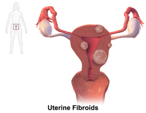 Fibroids. (Wikimedia Commons)