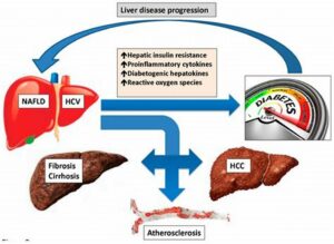 liver disease in diabetics