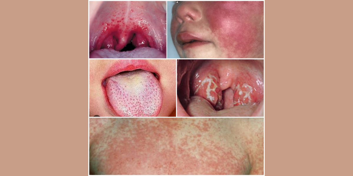 Throat infection, swollen tonsils, skin rash, fever are common symptoms of scarlet fever. (Supplied)