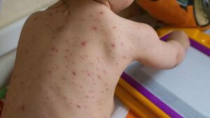 Chicken pox rash. (Wikimedia Commons)